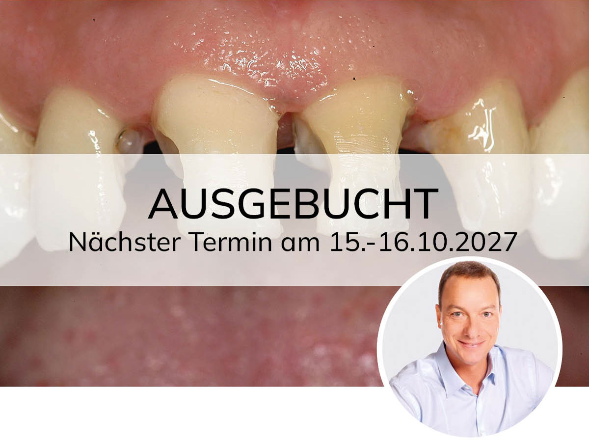 Adhäsive Restaurationen - an einem Wochenende