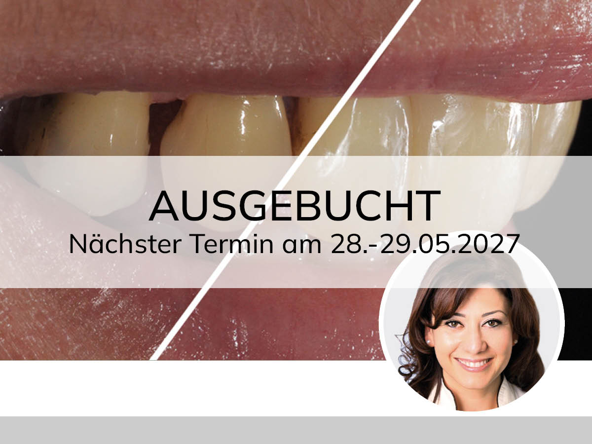 Hochästhetisches, nichtinvasives Veneering