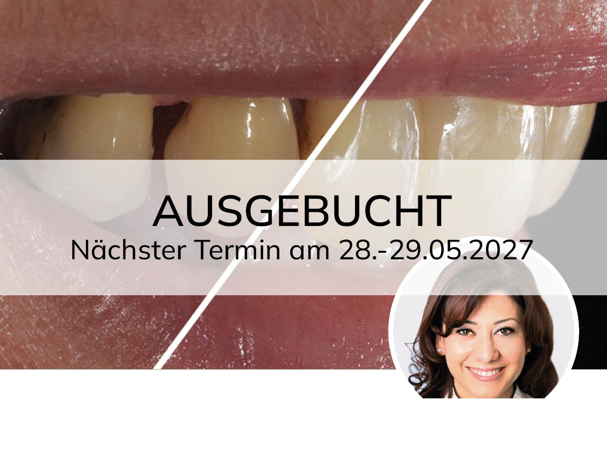 Hochästhetisches, nichtinvasives Veneering
