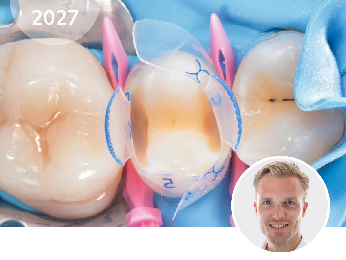 Bioclear Injection & Modern Composite Dentistry