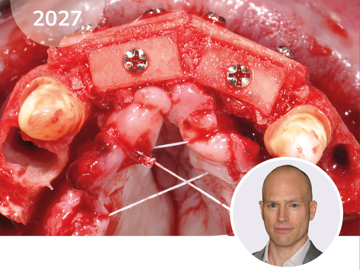 Simplify your Augmentation