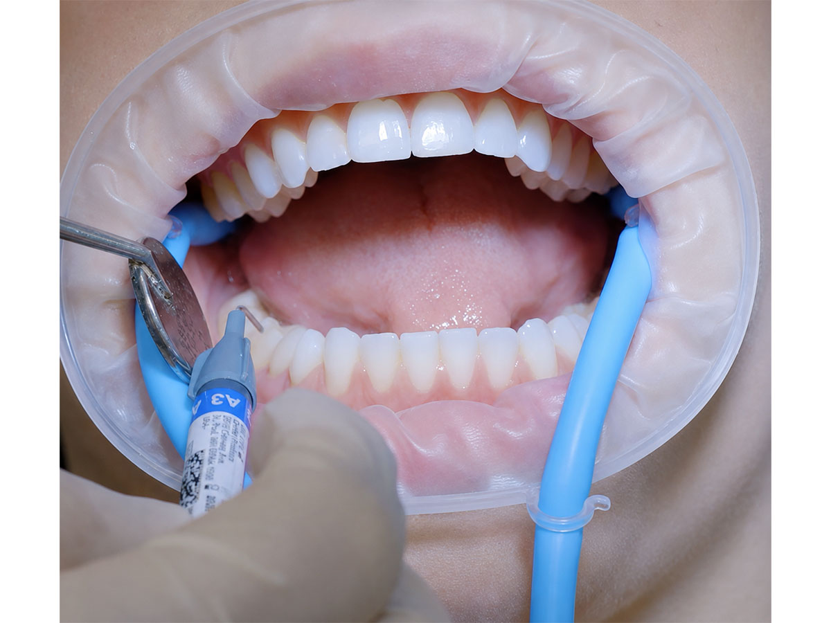 Hippo-D Large Refill – Retraktions- und Absaugsystem (50)