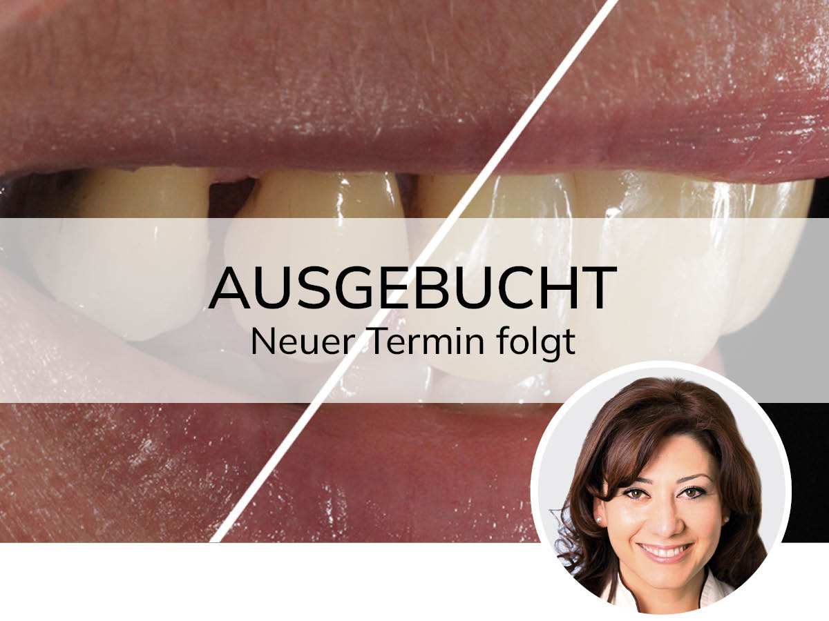 Hochästhetisches, nichtinvasives Veneering