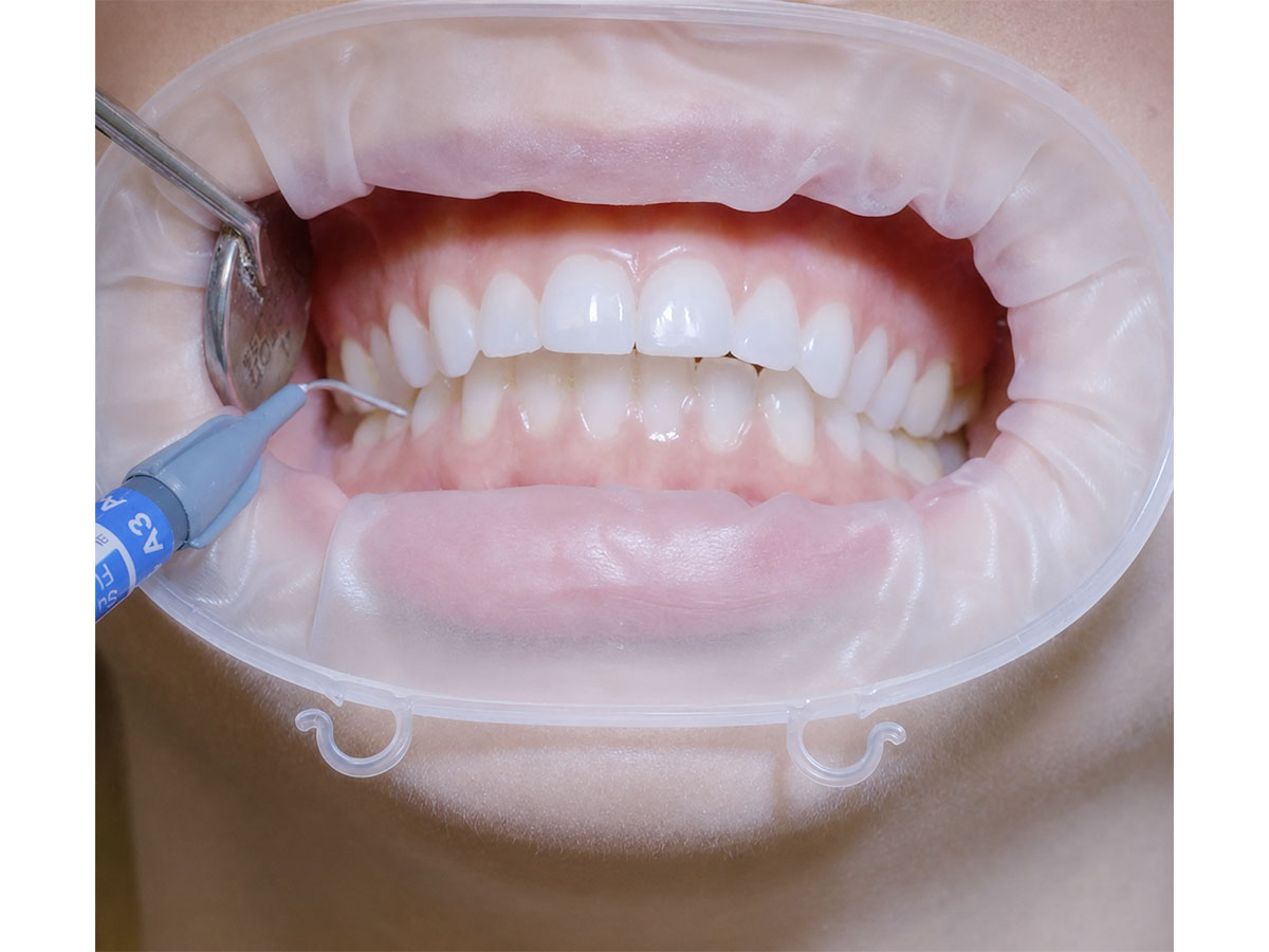 Hippo-U Large Refill - Retraktionssystem (50)