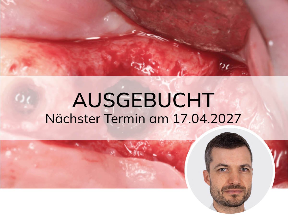 Osseodensification - Implantat-Präp. optimieren