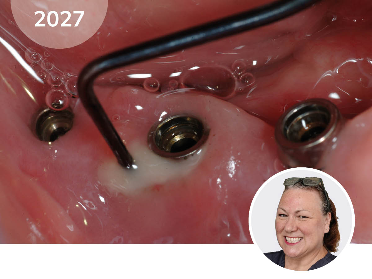 Periimplantäre Gesundheit professionell gestalten