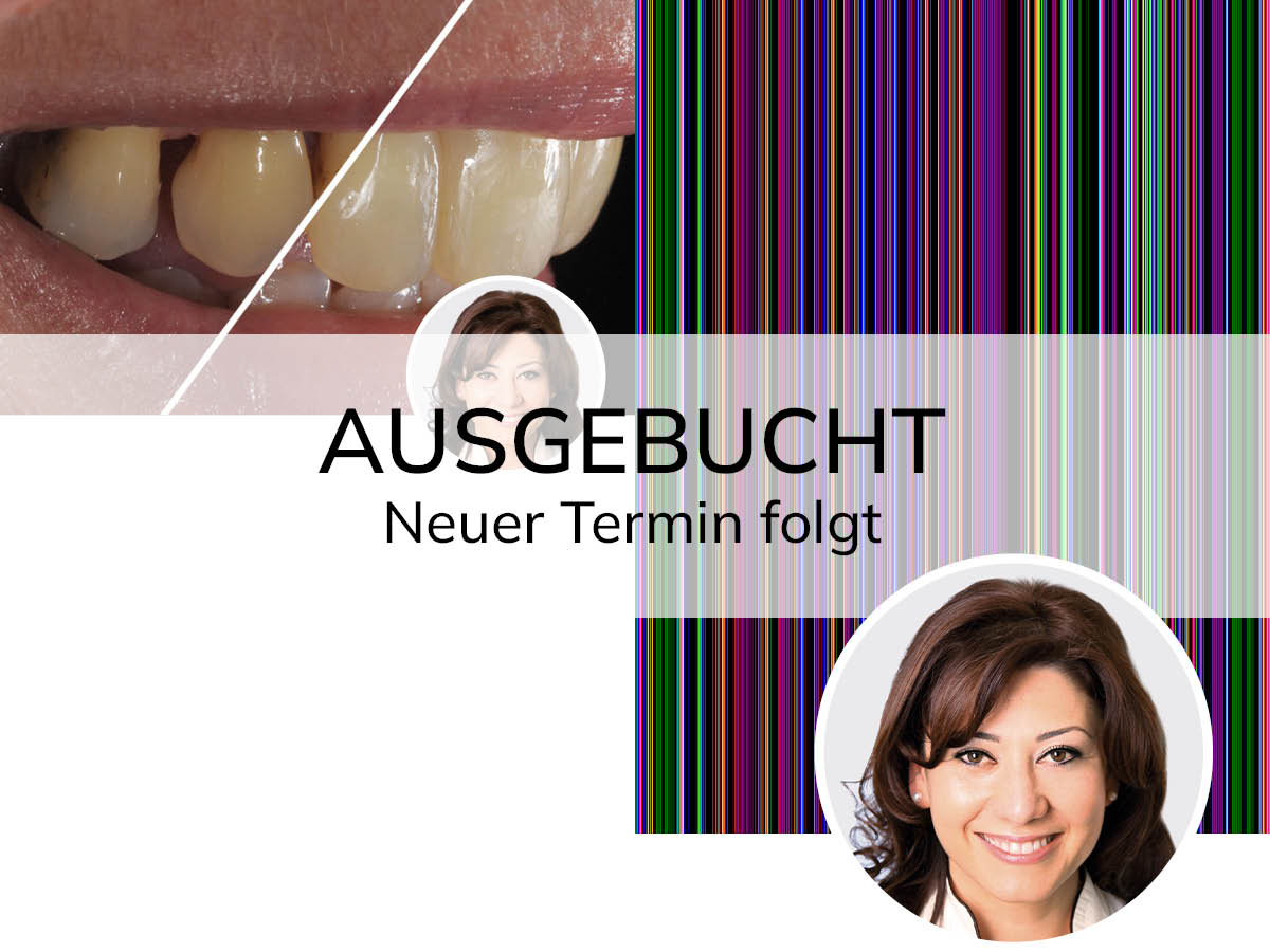 Hochästhetisches, nichtinvasives Veneering