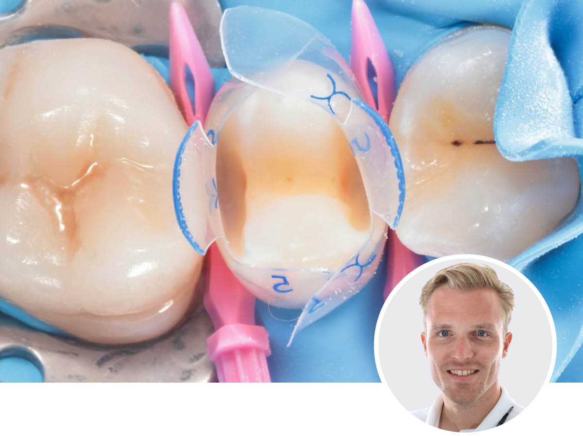 Bioclear Injection & Modern Composite Dentistry