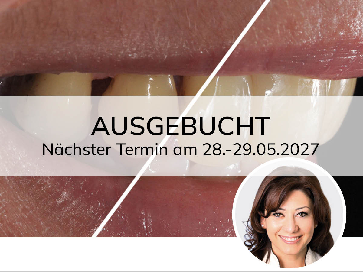 Hochästhetisches, nichtinvasives Veneering
