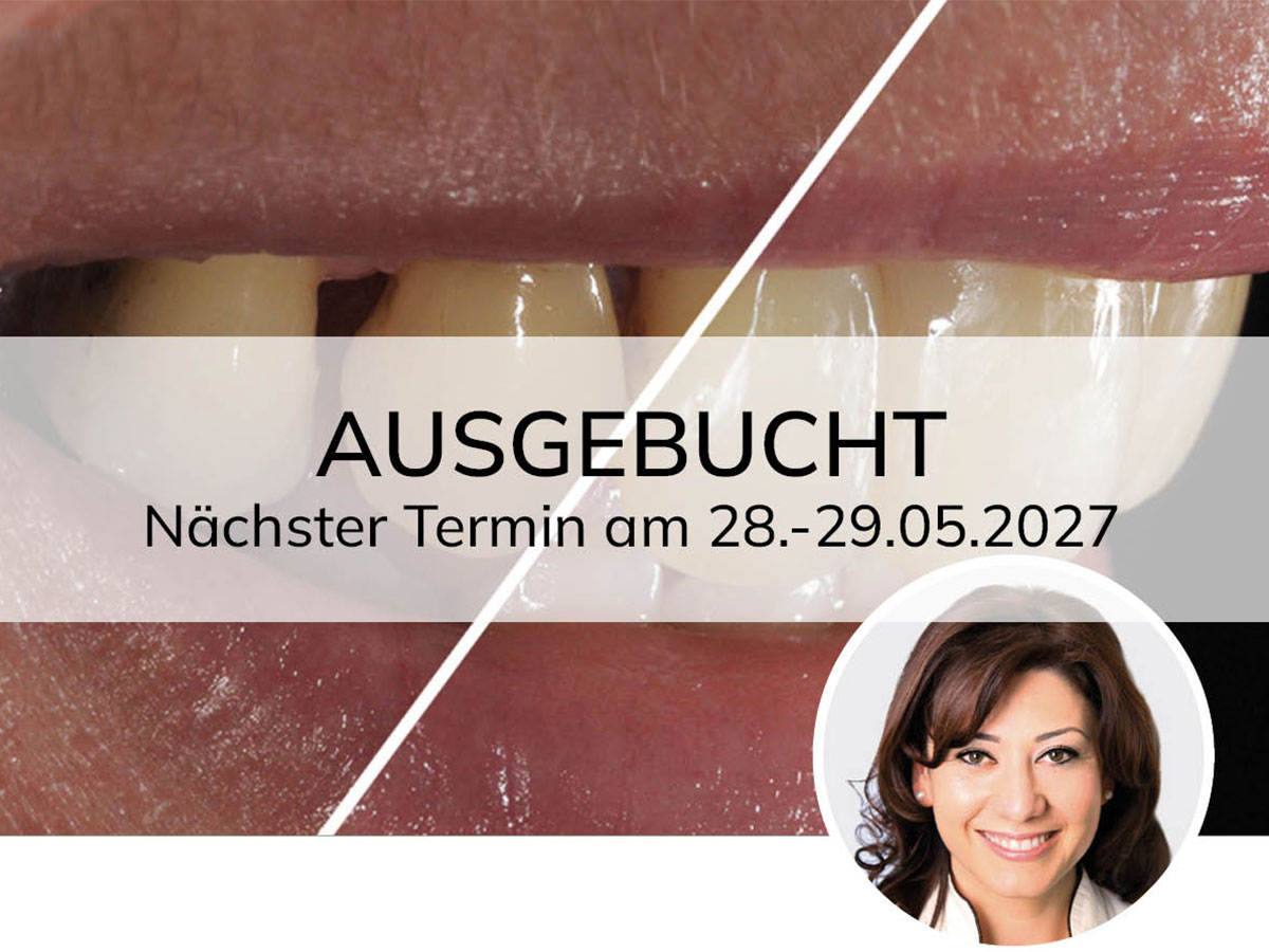 Hochästhetisches, nichtinvasives Veneering