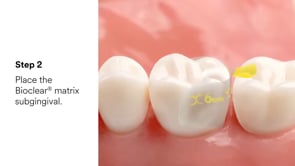 Evolve Posterior Matrix Black Premolar – 6 mm (50)